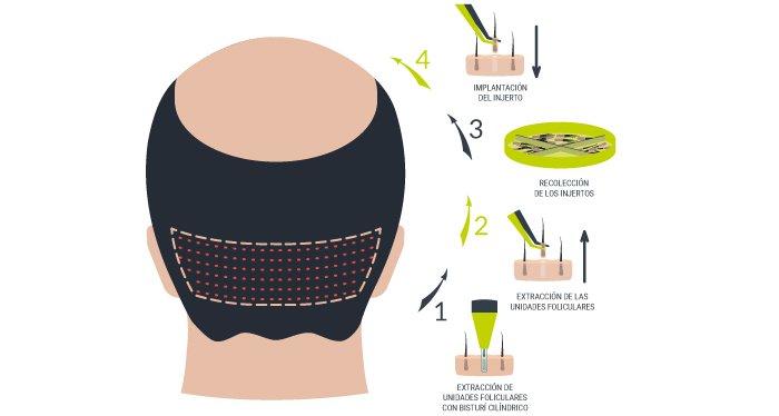 Procedimiento alopecia e implante de barba